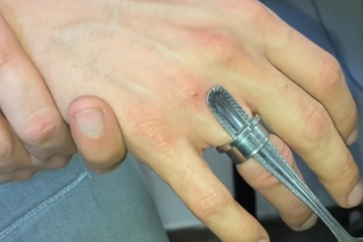 Fültágító szorult az ujjára, levágták - VIDEÓ