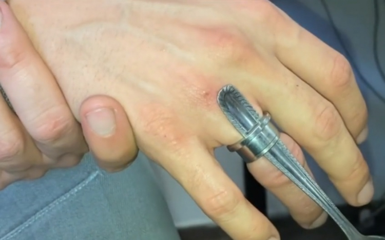 Fültágító szorult az ujjára, levágták - VIDEÓ