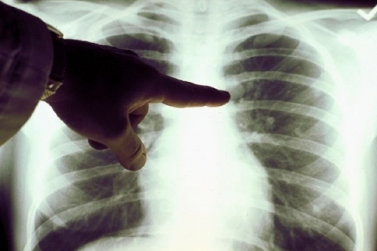 Tüdőszűrés lesz Kónyban