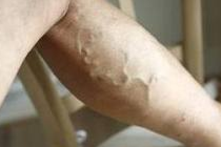 Hogyan csökkenthető a visszeres fájdalom? 